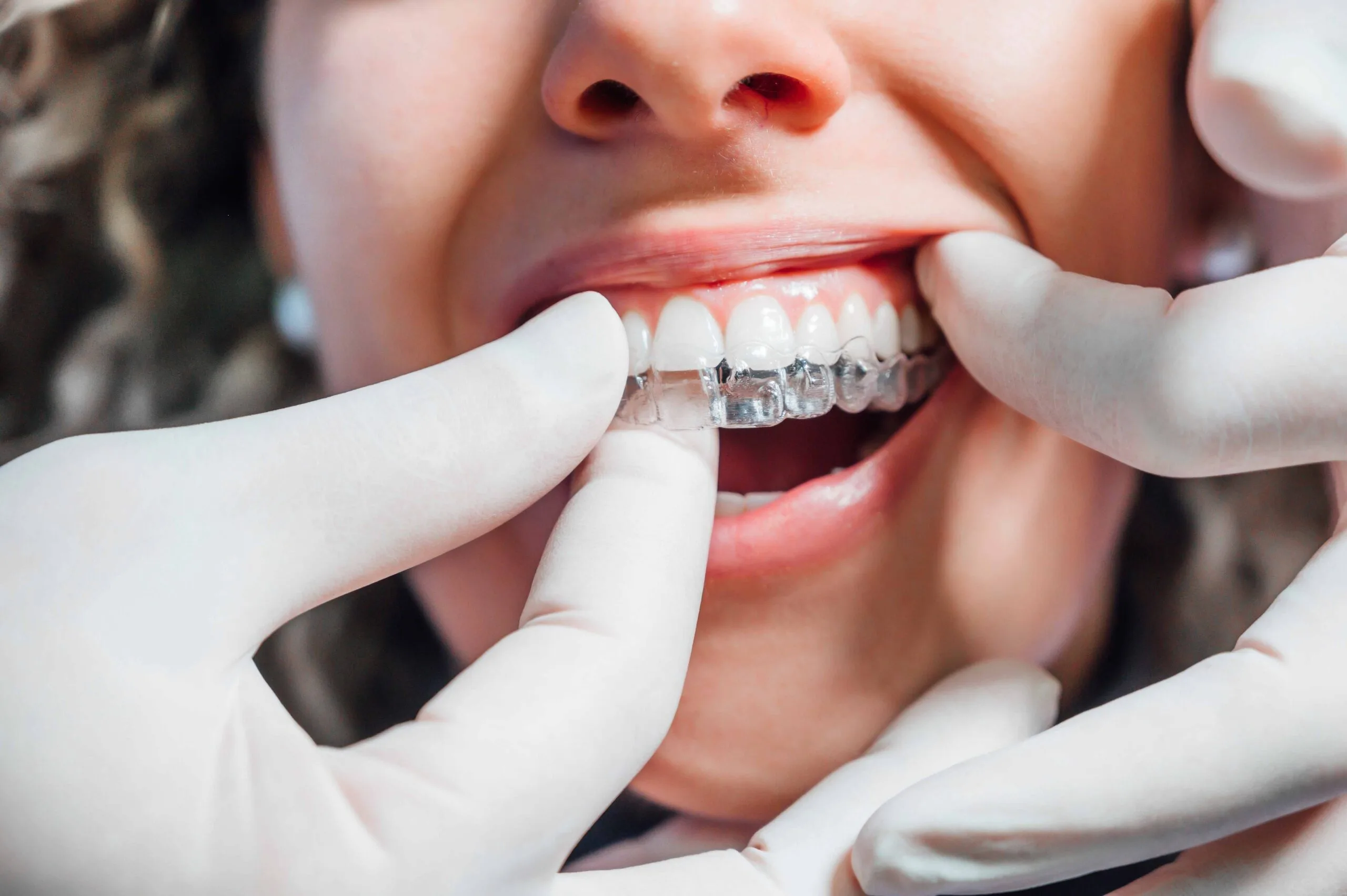 Clear Aligners Treatment