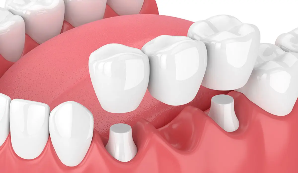 Dental Crown and Bridge Treatment