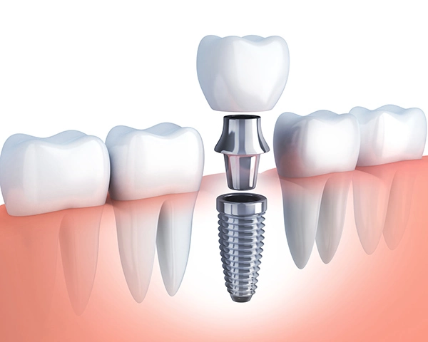 Dental Implants in Pune