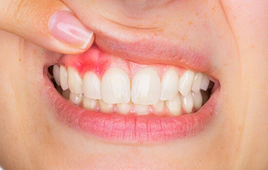Gum Treatment