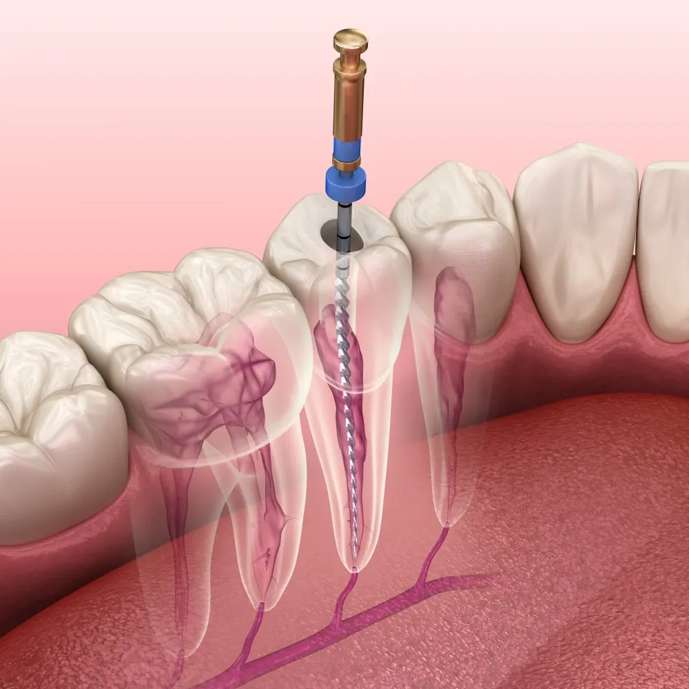 Root Canal treatment to save a damaged tooth and relieve pain