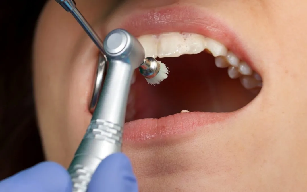 Teeth Whitening treatment for a whiter, brighter smile