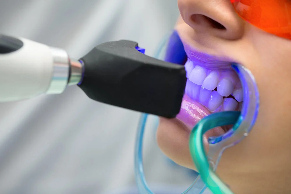 Teeth Whitening in Pune