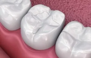 Tooth Colored Fillings Treatment