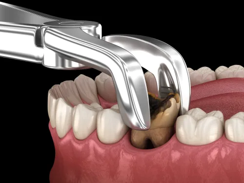 Tooth Extraction Treatment