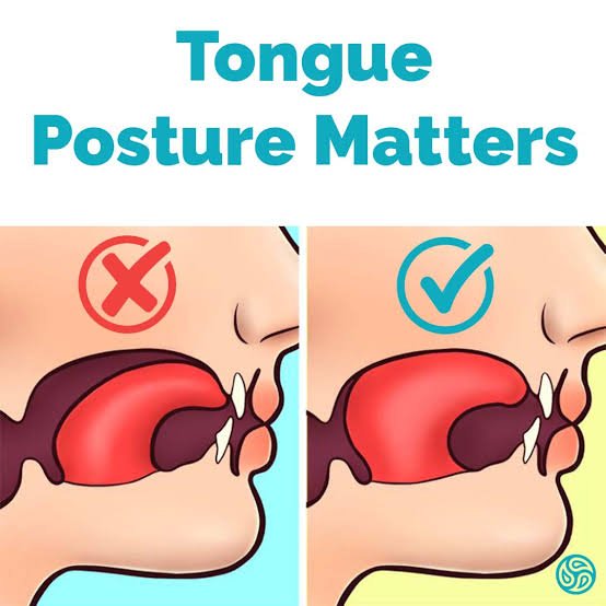 Illustration showing correct vs incorrect tongue posture