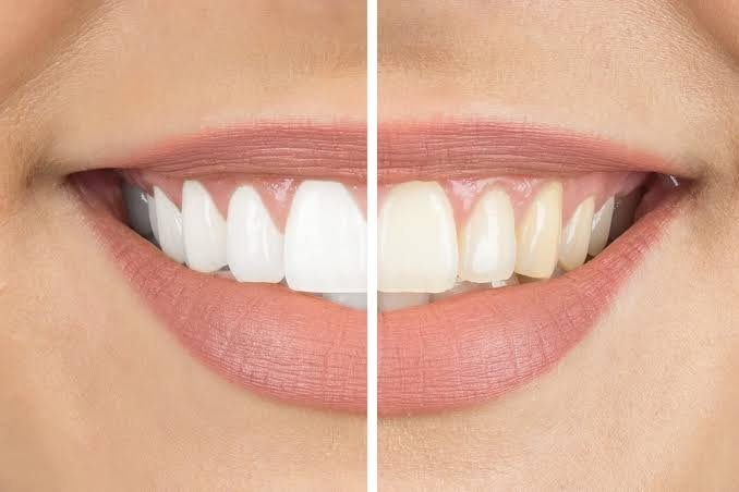 Comparison of teeth polishing and teeth whitening – left side shows naturally polished teeth, right side shows visibly whiter smile.