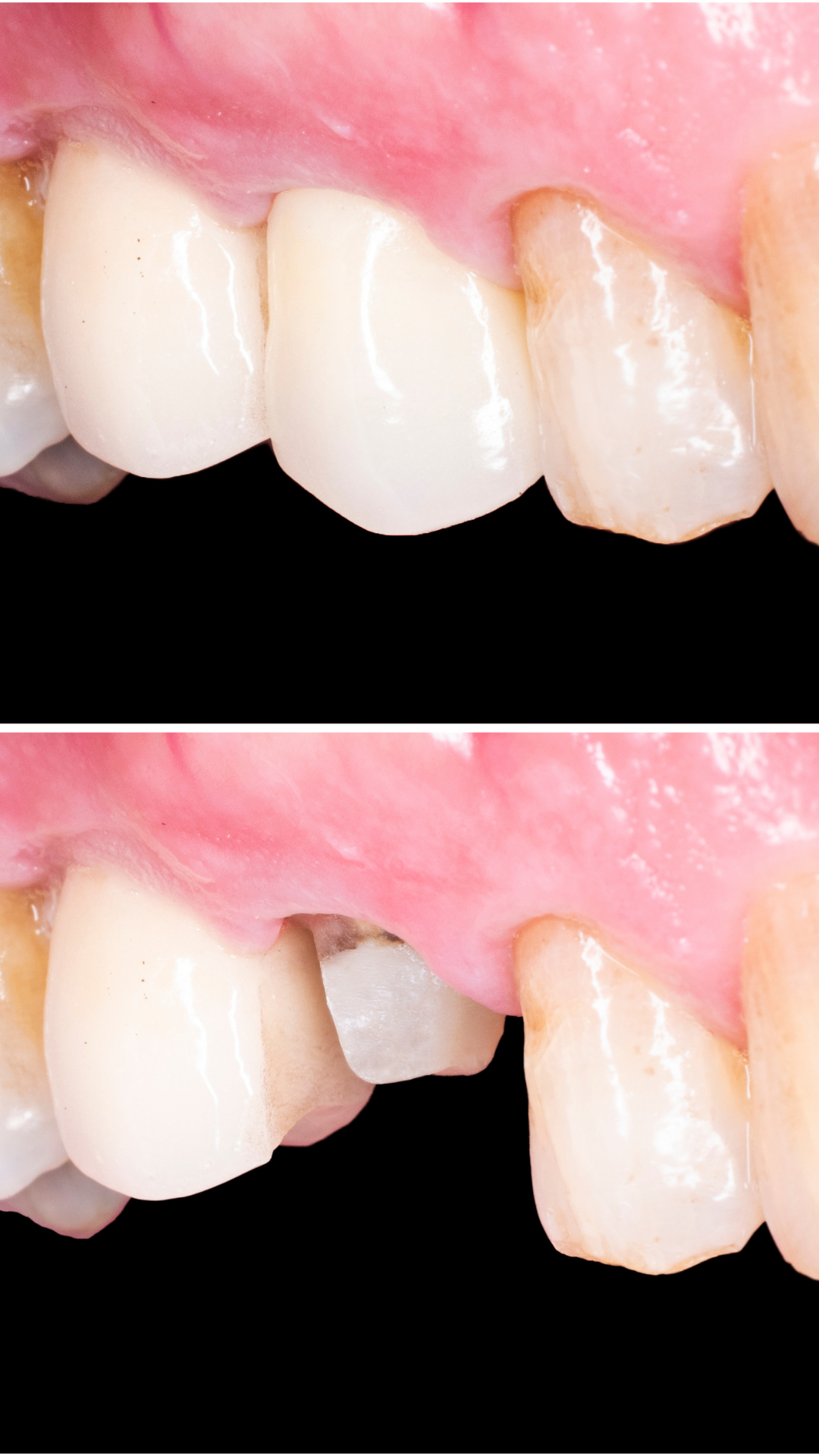 Cracked and weakened tooth near the gum line indicating the need for a dental crown