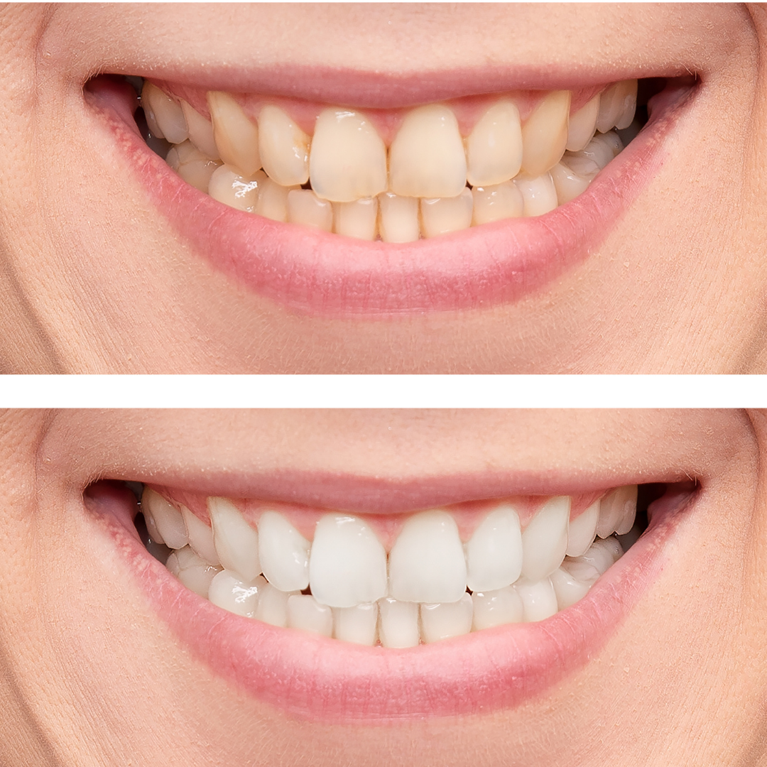 Before and after teeth whitening results - brighter, whiter smile transformation for special occasions like wedding