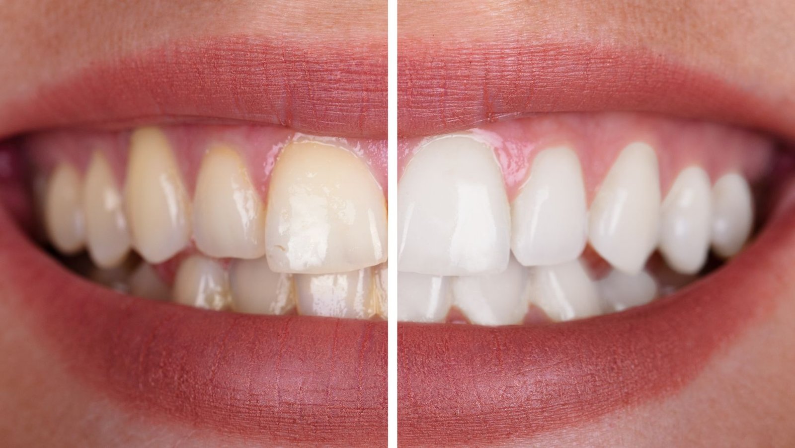 Before and after teeth whitening results showing a brighter festive smile.