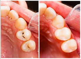 Comparison between healthy tooth and tooth with cavity