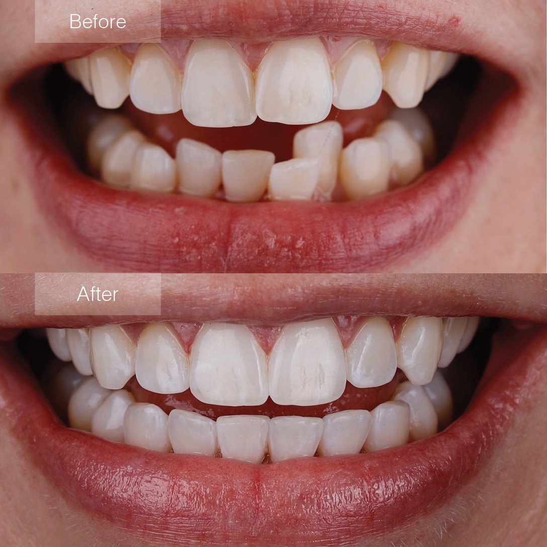Before and after tooth alignment showing improved smile and better oral hygiene