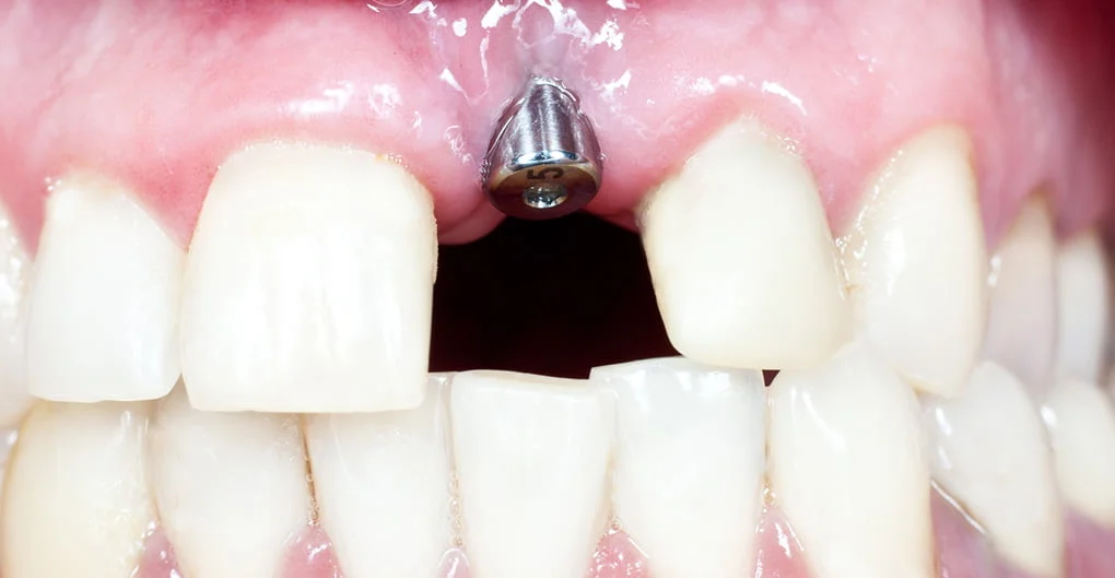 Dental implant procedure showing titanium implant placed in jawbone