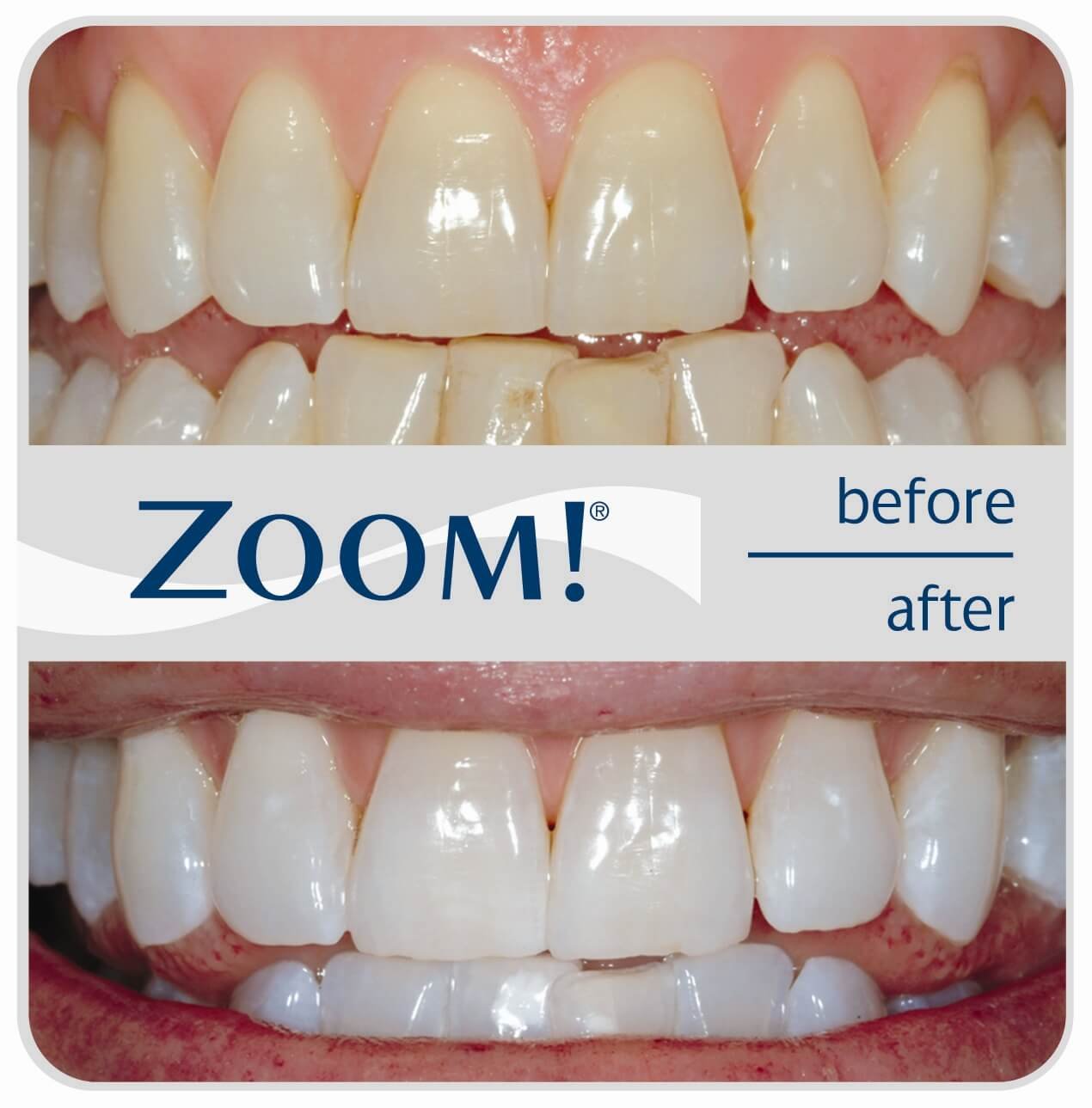 Teeth whitening transformation using Zoom at Dental Care Solutions.