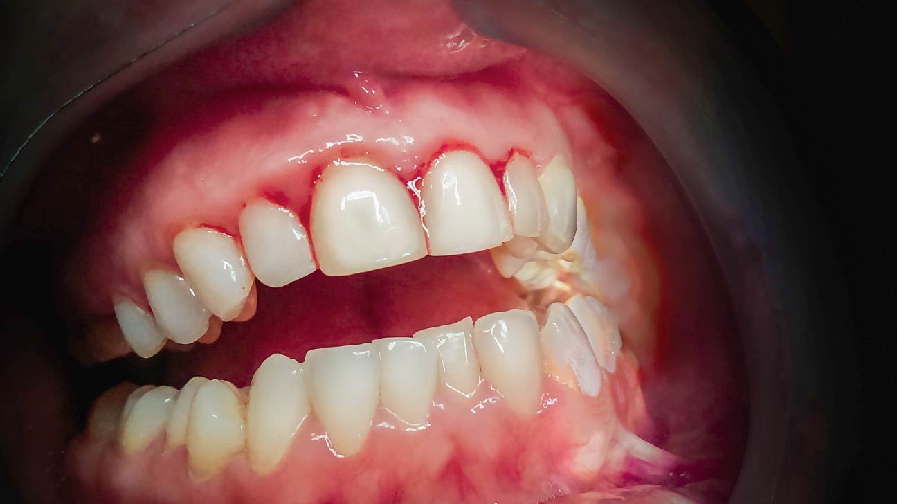 Bleeding gums while brushing teeth showing early signs of gingivitis