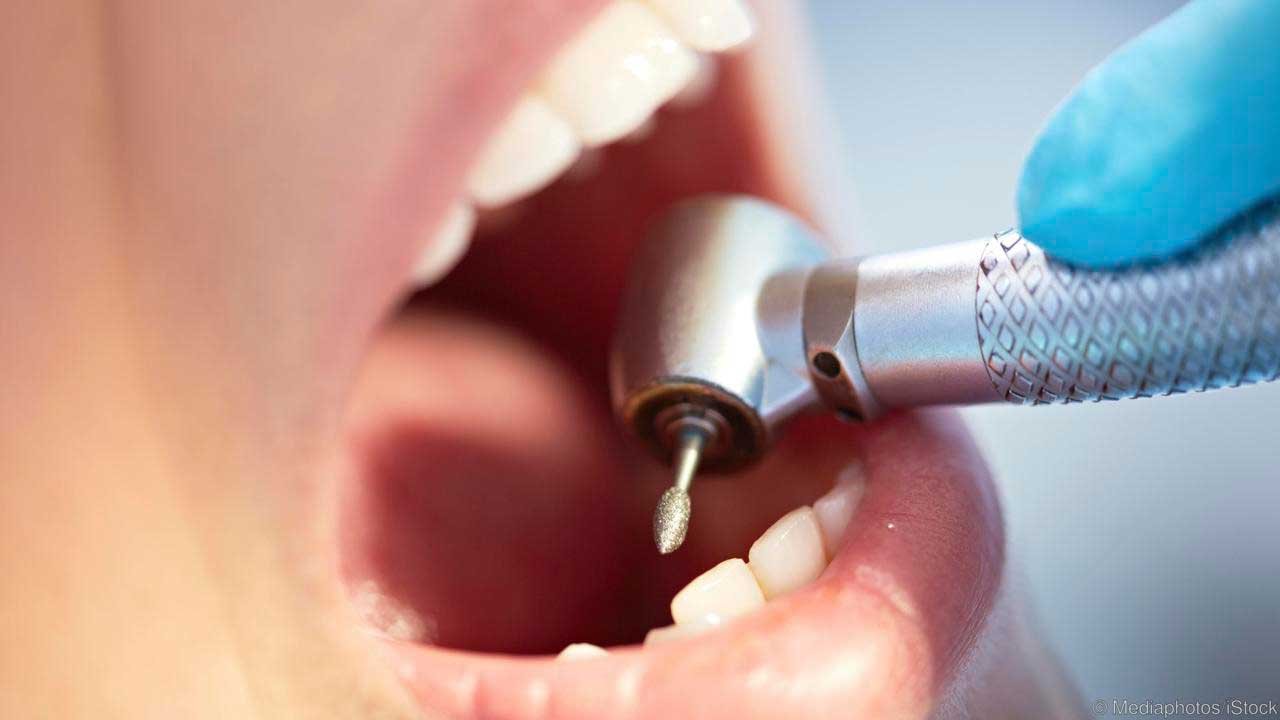 Dentist using a dental drill to treat a cavity in a patients tooth