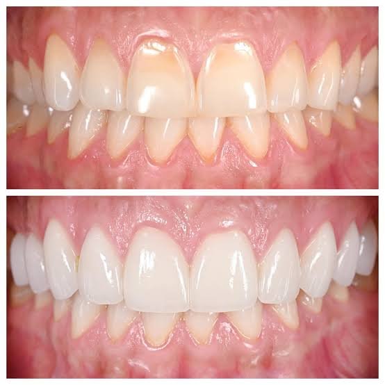 Enamel erosion caused by acidic drinks and lifestyle habits